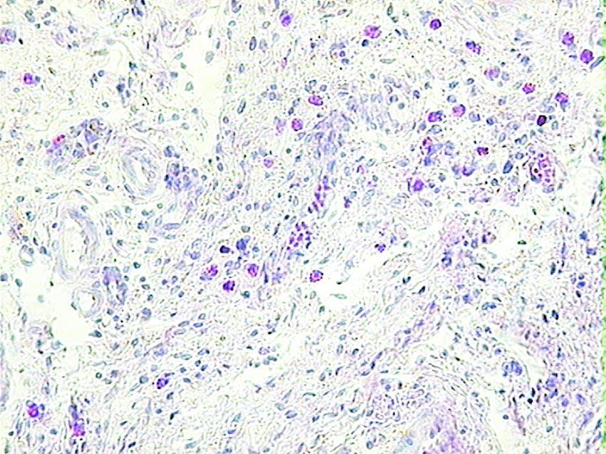 1, liczebnoœæ makrofagów nie by³a bezpoœrednio zwi¹zana z procesem narastania zmian patologicznych w endometrium o charakterze endometrosis.