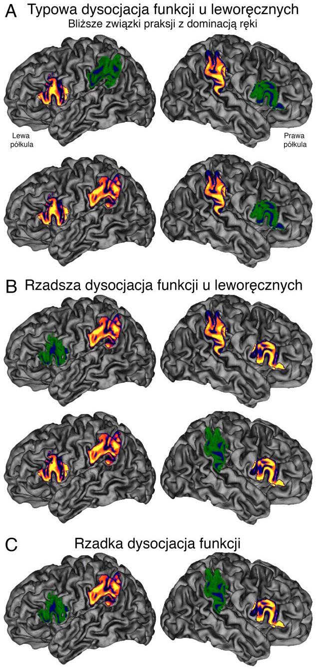 Ilustracja 4. Przykłady możliwych dysocjacji pomiędzy praksją a językiem u osób leworęcznych. (A) Dysocjacja typowa.