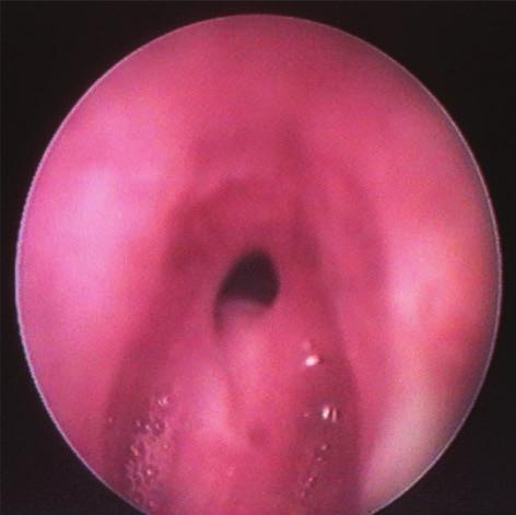 Grade III subglottic stenosis according to Myer Cotton Grading System Ryc. 2.