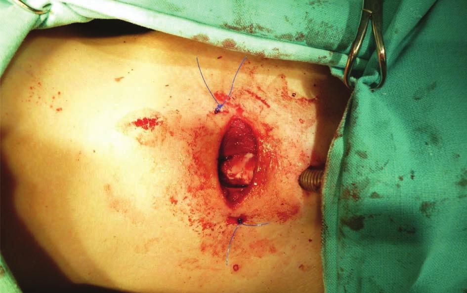 The cartilage was harvested from the 6 th rib, and the harvested graft was processed and implemented in the subglottic region, enabling to expand its diameter (fig. 3).