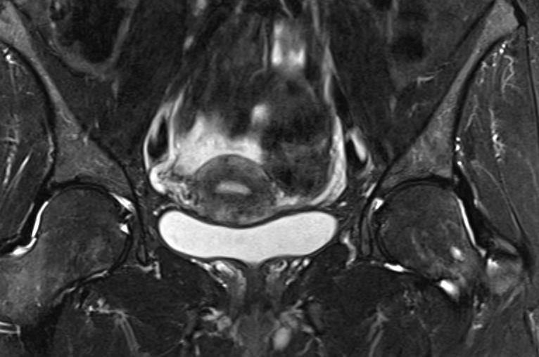 MR macica Obrazy T2-zależne endometrium: