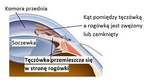 W przypadku jaskry zamykającego się kąta przesączania specyficzna budowa przedniej części oka powoduje, że odpływ cieczy wodnistej jest blokowany przez tęczówkę. Do zaburzenia może dojść np.