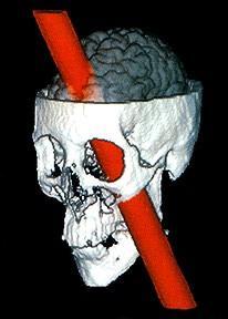 Brzuszno przyśrodkowa kora czołowa - przypadek Phineasa Gage a i hazard Brzuszno przyśrodkowa kora czołowa (ventromedial frontal cortex) bierze udział w regulacji emocji i zachowania poprzez