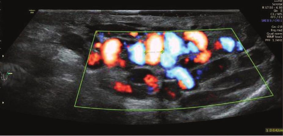 Badanie fizykalne stanowi standardową metodę diagnostyczną stosowaną w celu wykrycia żylaków powrózka nasiennego, ale rozpoznanie bezobjawowej i niewyczuwalnej palpacyjnie choroby jest niezwykle