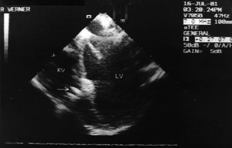 Folia Cardiol. 2002, tom 9, nr 2 nasiliła się. Zapis EKG wskazywał na ustąpienie cech przeciążenia lewej komory serca. Przypadek 2. U chłopca K.T.