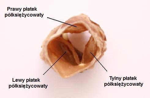 z wiekiem, zmiany reumatyczne oraz wrodzone (zastawki dwupłatkowe aorty ulegają szybciej zwyrodnieniu niż trójpłatkowe). Rys. 1.7.