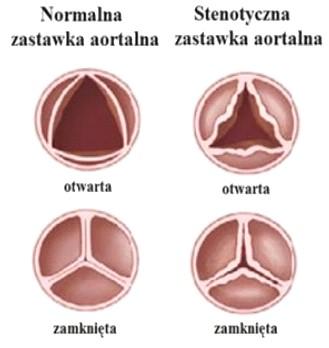 kręgów L1/S1 wynosi >12.5 mm, podczas gdy średnica o wartości <12 mm jest uważana za stenotyczną [78]. Rys. 1.8. Zdrowa i zdegenerowana zastawka aortalna na skutek stenozy aortalnej.