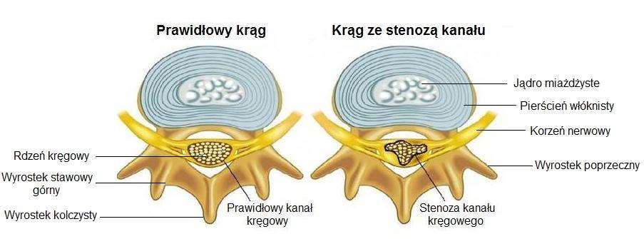 Rys. 1.9. Anatomia kręgu wraz z obrazem prawidłowego i zwężonego kanału kręgowego. Więzadła żółte (LF, ang. ligamenta flava) to struktury zlokalizowane pomiędzy łukami sąsiednich kręgów.