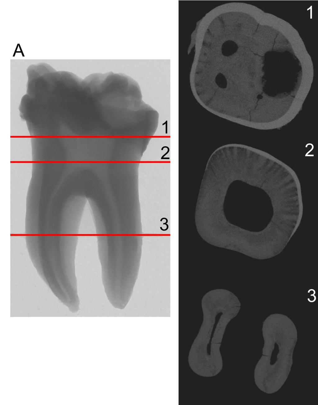 Rys. 2.2. Przykładowa rekonstrukcja obrazu trzech wybranych przekrojów zęba trzonowego, zaznaczonych na rysunku A. Pomiar wykonany z rozdzielczością 13.