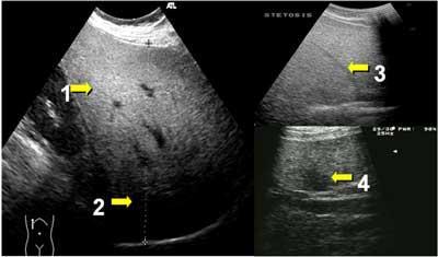 Stłuszczenie wątroby w badaniu USG 1 hiperechogeniczność miąższu 2 wzmożona atenuacja 3 gorzej widoczne naczynia 4
