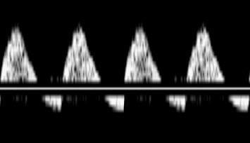 reversed end diastolic velocity) Czynnik diagnostyczny: UA PI rozpoznawanie wczesnego