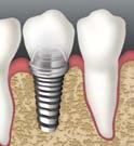 Previzibil, sigur şi comod sigur chiar şi comod şi la revizii frecvente! Reconstrucţia protetică Liant implant implant OliREVO set 6 6 seringi 4g în nuanţele: A1, A2, A3, A3.