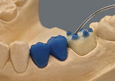Dodatkowo można zastosować technikę CAD/CAM oraz bloczki VITA CAD-Waxx z polimeru akrylowego.
