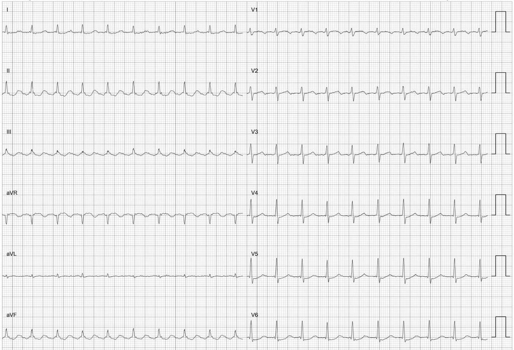 12-lead ECG of atrial flutter recorded before first ablation Rycina 5.