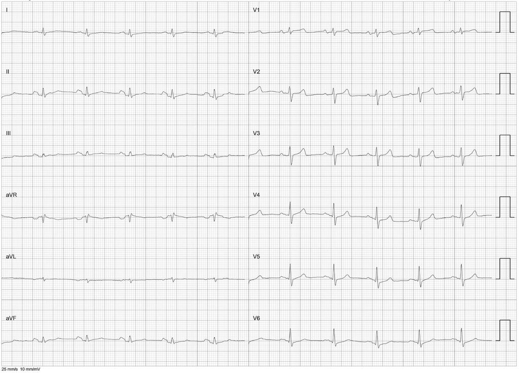 72 J. Adamowicz i in. Rycina 6. 12-odprowadzeniowe EKG przedstawiające rytm zatokowy po drugiej procedurze Figure 6.