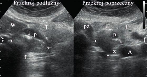 . Jelito cienkie 95 Rycina 185. Przekrój poprzeczny na poziomie trzustki. Pod głową trzustki (P) widoczne pasmo echogeniczne odpowiadające gazowi w uchyłku okołobańkowym dwunastnicy (strzałka).