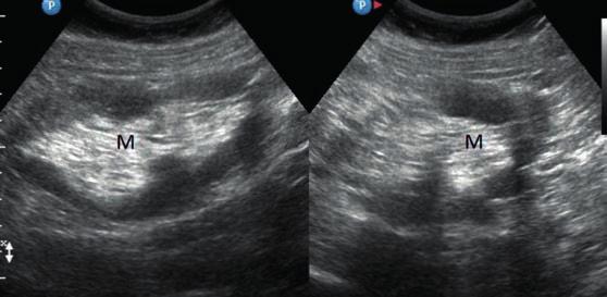 Kryteriami rozpoznania tego zespołu (the superior mesenteric artery syndrome) są: kąt odejścia tętnicy krezkowej górnej od aorty mniejszy niż 22 i/lub mniejsza niż 8 mm odległość między tętnicą