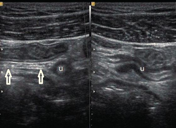 90 Przewodnik przezskórnej ultrasonografii cewy pokarmowej Rycina 171. Na dwóch przekrojach oznaczono uchyłek Meckla (u) wyglądem przypominający wyrostek robaczkowy.