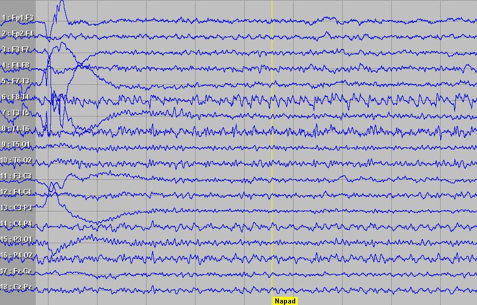 EEG 1