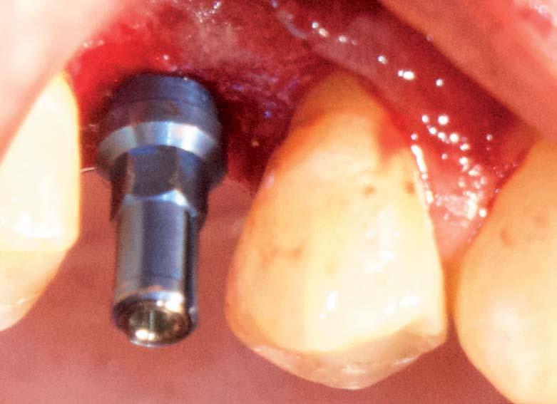 Intraosseous implant position in upper dental arch Rycina 8.