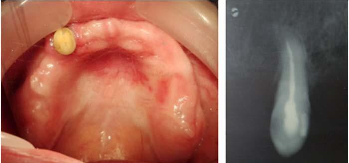 Stan po zdjęciu korony lanej z zęba 23 oraz zdjęcie rtg zęba 23 po leczeniu endodontycznym Figure 7.