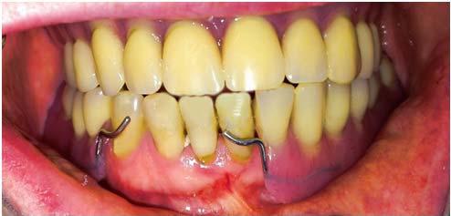 Rehabilitacja protetyczna pacjenta z zespołem Kelly ego opis przypadku Rycina 10. Kontrola protez próbnych na modelach roboczych Figure 10. Wax try-in of the upper and lower dentures Rycina 11.
