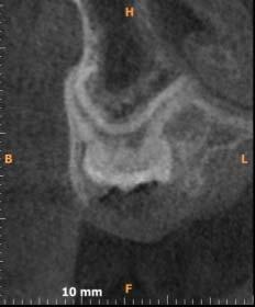 Celem pracy jest zaprezentowanie przypadku pacjentki, u której wykonanie badania tomografii wolumetrycznej pozwoliło na zaobserwowanie reinkludowanego mlecznego zęba trzonowego w szczęce po stronie