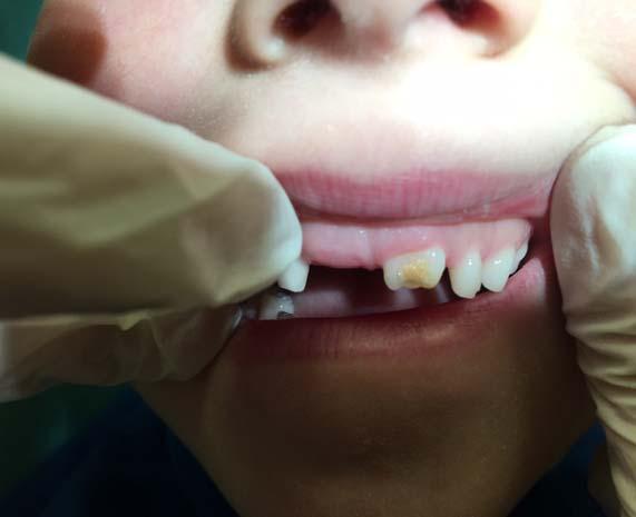 Zaburzenia rozwojowe szkliwa i ich związek z występowaniem próchnicy zębów przegląd piśmiennictwa Rycina 1. Hipoplazja szkliwa powikłana próchnicą w zębie 21 u sześcioletniego pacjenta Figure 1.