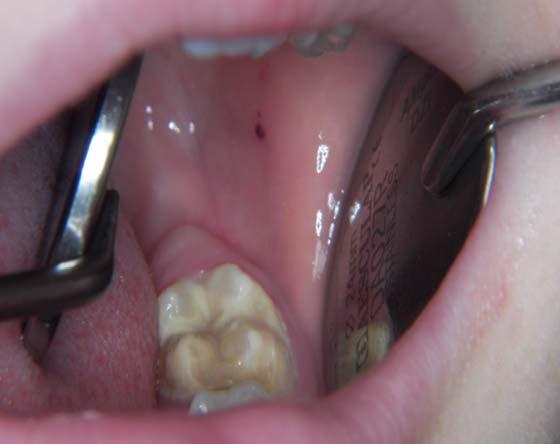 Tooth 15 with cariotic demineralization of abnormal enamel in an 11-year-old patient. Enamel hypomineralisation resulting from chronic periapical inflammation of tooth 55 (Turner s tooth) Rycina 3.