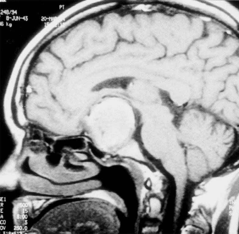 Czynność tarczycy a: Prolaktynoma ucisk TSH, g. mix TSH Akromegalia g. mix TSH, IGF-1 stym. t. Ch. Cushinga kortyzol TSH, ft 4 ft 3 Gruczolaki nieczynne Tyreotropinoma ucisk TSH, wydz. h.