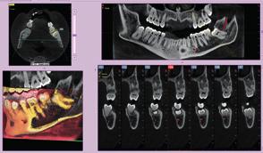 średniej budowie odległość pomiędzy trzecimi zębami trzonowymi po lewej i prawej stronie, uwzględniając odpowiadające im korzenie, wyrostek zębodołowy i otaczającą kość, wynosi 9 cm.