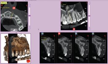 Badania endodontyczne Leczenie kanału żuchwowego oraz identyfikacja mikropęknięć i resorpcji korzeni: wyjątkowa