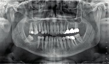 Pantomogram ortogonalny: minimalizuje nakładanie się sąsiadujących zębów i zapewnia
