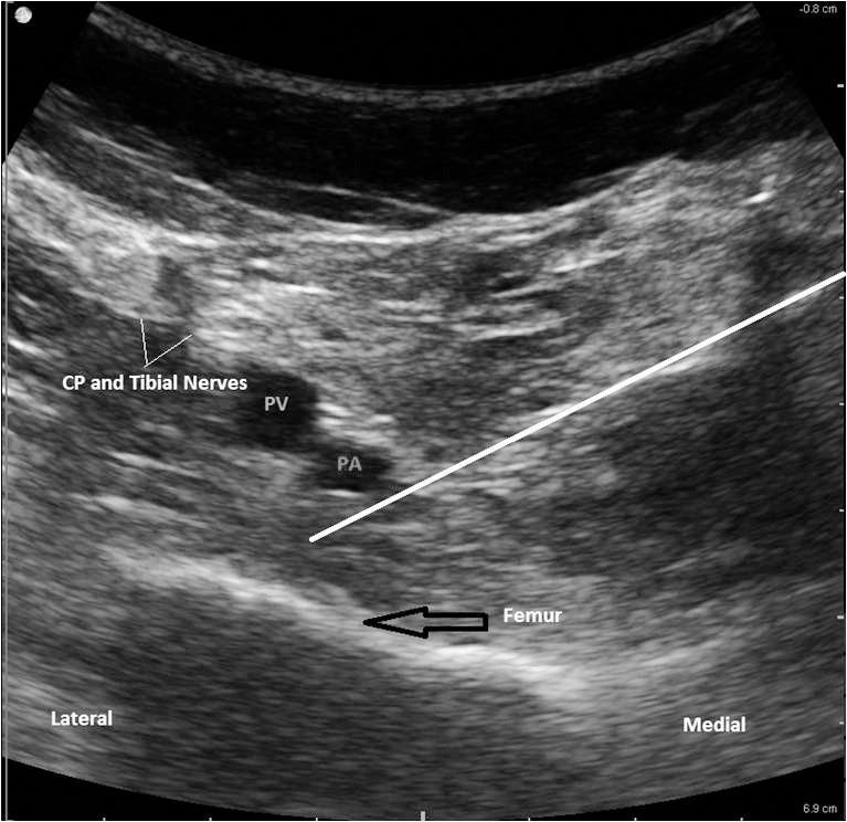 ipack Infiltration between Popliteal Artery and Capsule of Knee Podanie 20-30ml LMZ pomiędzy tętnicą podkolanową a tylną torebką stawu kolanowego CEL: splot