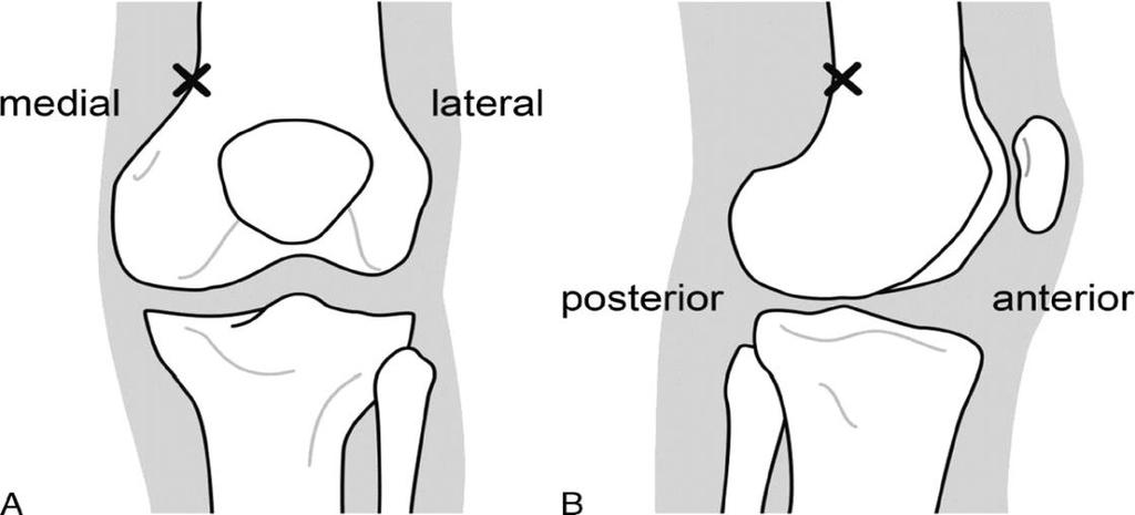 Blokada SPANK (Sensory Posterior Articular Nerves of the Knee) Podanie 20ml 0,25%