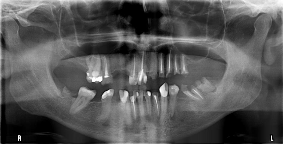 1/2018 Przypadek 2 Pacjent M.Z., lat 43, został skierowany na specjalistyczne leczenie zęba 34.