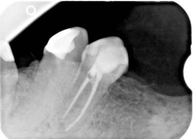 Na zdjęciu panoramicznym wykonanym przed leczeniem stwierdzono przy zębie 34 obecność zmian okołowierzchołkowych (ryc. 13). Po założeniu koferdamu usunięto opatrunek.