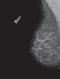 dotykania ekranów w trakcie skanowania i kasowania Zapewnia jakość obrazu optymalną dla mammografii dzięki