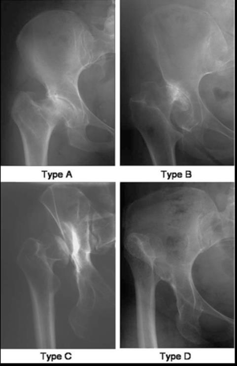 Typ A Typ B Typ C Typ D Rycina 2. podział Eftekhar a w obrazie radiologicznym.