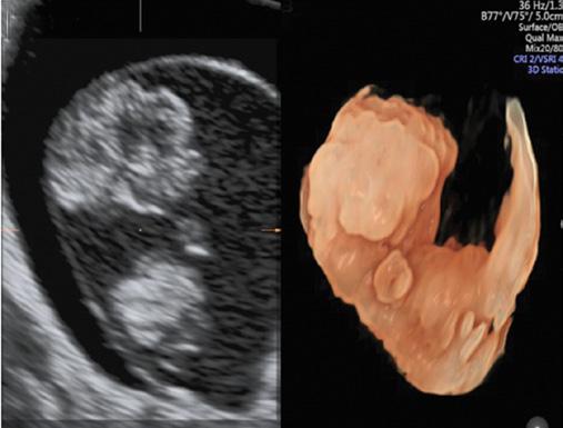 Charakterystyka fenotypowa sekwencji akrania egzencefalia anencefalia z zastosowaniem ultrasonografii dwu- i trójwymiarowej między 11. a 13. tygodniem i 6.