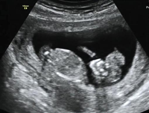 Wytyczne Międzynarodowego Towarzystwa Ultrasonografii w Ginekologii i Położnictwie (International Society of Ultrasound in Obstetrics and Gynecology, ISUOG) dotyczące badań w pierwszym trymestrze