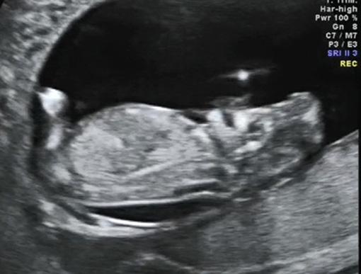Ultrasonografia 3D w prezentacji wieloplanarnej w płaszczyźnie strzałkowej (, szczegółowa) oraz strzałkowej i czołowej (): dobrze widoczny fenotyp zwisający dniu i 3. dniu ciąży oraz od 10.