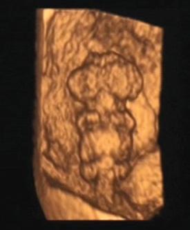 Zastosowanie standaryzowanego protokołu w ocenie ultrasonograficznej anatomii zarodka lub płodu ma kluczowe znaczenie dla wczesnej diagnostyki prenatalnej zaburzeń płodu.