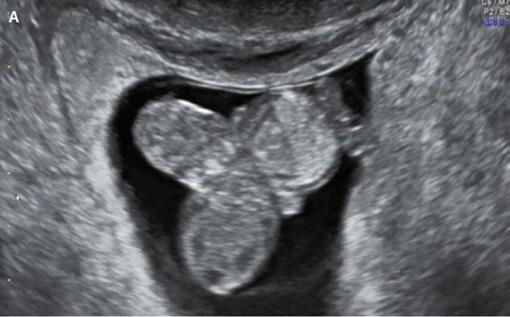 dniu ciąży grafia przezpochwowa 3D stanowiła uzupełnienie wczesnej diagnozy prenatalnej sekwencji akrania/egzencefalia i okazała się skuteczna w wykluczeniu innych zaburzeń, takich jak iniencefalia