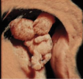 Ultrasonografia trójwymiarowa, zwłaszcza w pierwszym trymestrze ciąży, oraz zastosowanie dostępu przezpochwowego w celu obrazowania w płaszczyźnie czołowej i strzałkowej mogą być szczególnie pomocne