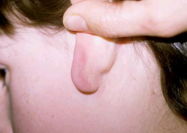 Ziarniniak chłonny (Lymphocytoma) Niebolesny, sino-czerwony guzek Pojedynczy, twardy Do kilku cm średnicy Płatek ucha, brodawka sutkowa, rzadziej moszna Rozwija się po ok.