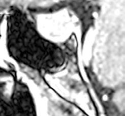 Endokrynologia Polska 2016; 67 (Supl. B) Rycina 2. Obraz MRI gruczolaka somatotropowego przysadki u badanego chorego Tabela I.