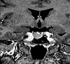 Problemy terapeutyczne u chorej z akromegalią w przebiegu zespołu MEN 1 Joanna Malicka, Maria Kurowska Rycina 5. Guz okolicy trzustki w CT Rycina 2. Obraz MRI makrogruczolaka przysadki Rycina 3.