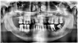 Problemy stomatologiczno-ortodontyczne ważne objawy akromegalii Katarzyna Potoczek-Wallner et al. Rycina 5. Pantomogram Rycina 6.