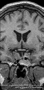 Endokrynologia Polska 2016; 67 (Supl. B) A Rycina 1. Obecny obraz MRI w projekcji czołowej (A) przed i po podaniu środka kontrastowego (B).